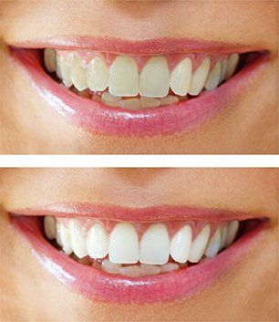 zoom teeth whitening process