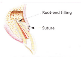 Endodontic Surgery | Apicoectomy | Dekalb, IL