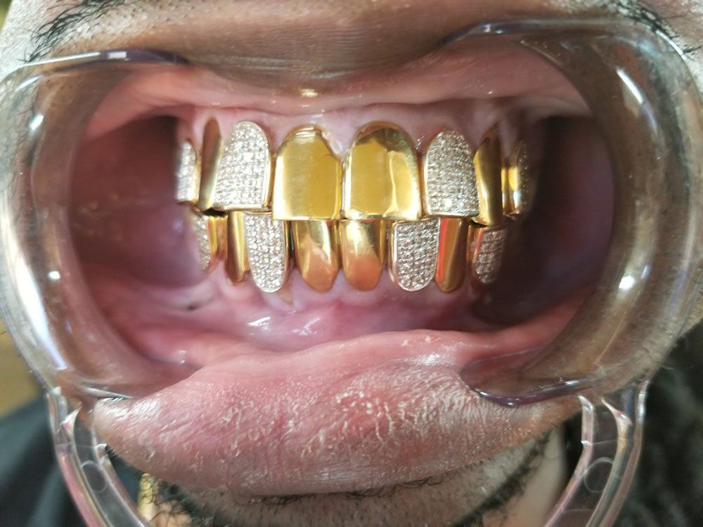 gold-crowns-gold-dental-work-mobile-al