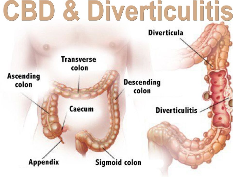 diverticulitis-and-cbd