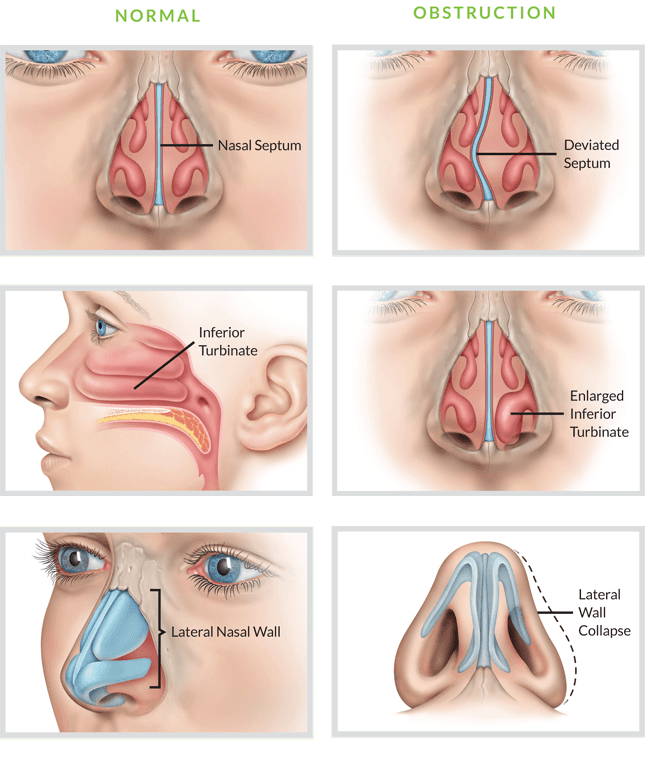 nasal obstruction